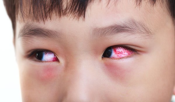hình ảnh đau mắt đỏ ở trẻ em